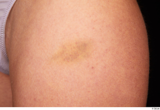 Waja bruise skin 0002.jpg